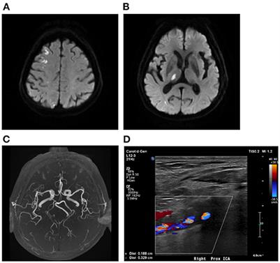 Distinct lesion features and underlying mechanisms in patients with acute multiple infarcts in multiple cerebral territories